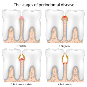 Source: Periodontaldiseasetreatment.org