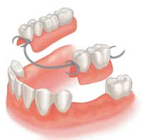 diagram of removable partial dentures